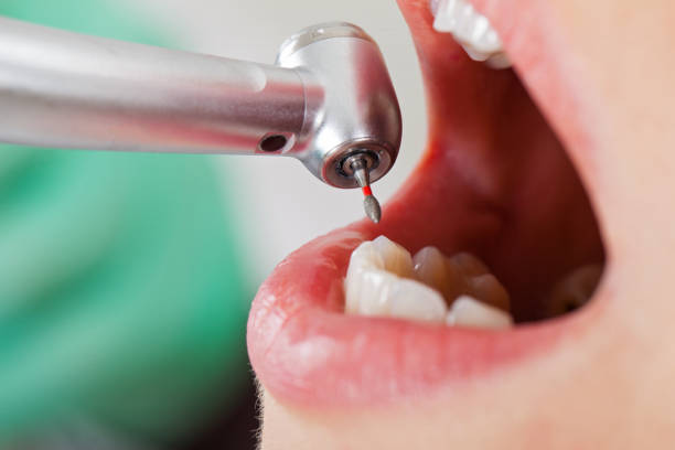 Best Emergency Dental Care for Abscessed Tooth in Kelseyville, CA